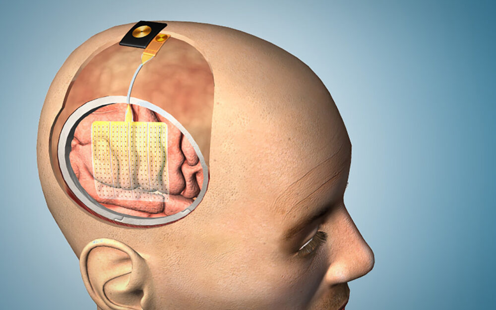 A brain sensor grid to enable treatment of drug-resistant epilepsy.